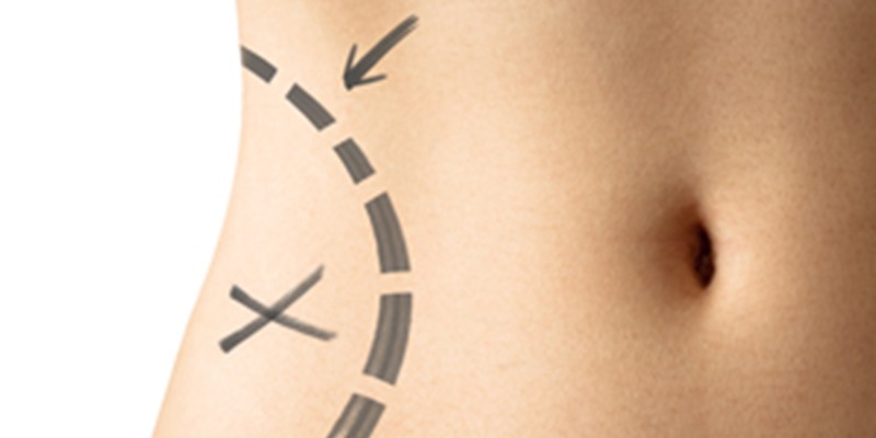 VASER LIPOSUCTION