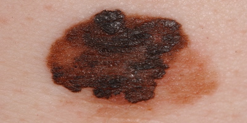 MALIGN MELANOMA