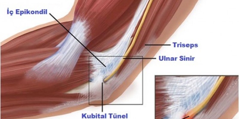 KUBİTAL TÜNEL SENDROMU