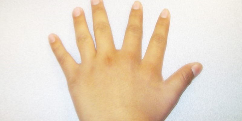 POLIDAKTILI SINDAKTILI